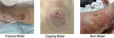 Inflammation-related proteomics demonstrate landscape of fracture blister fluid in patients with acute compartment syndrome